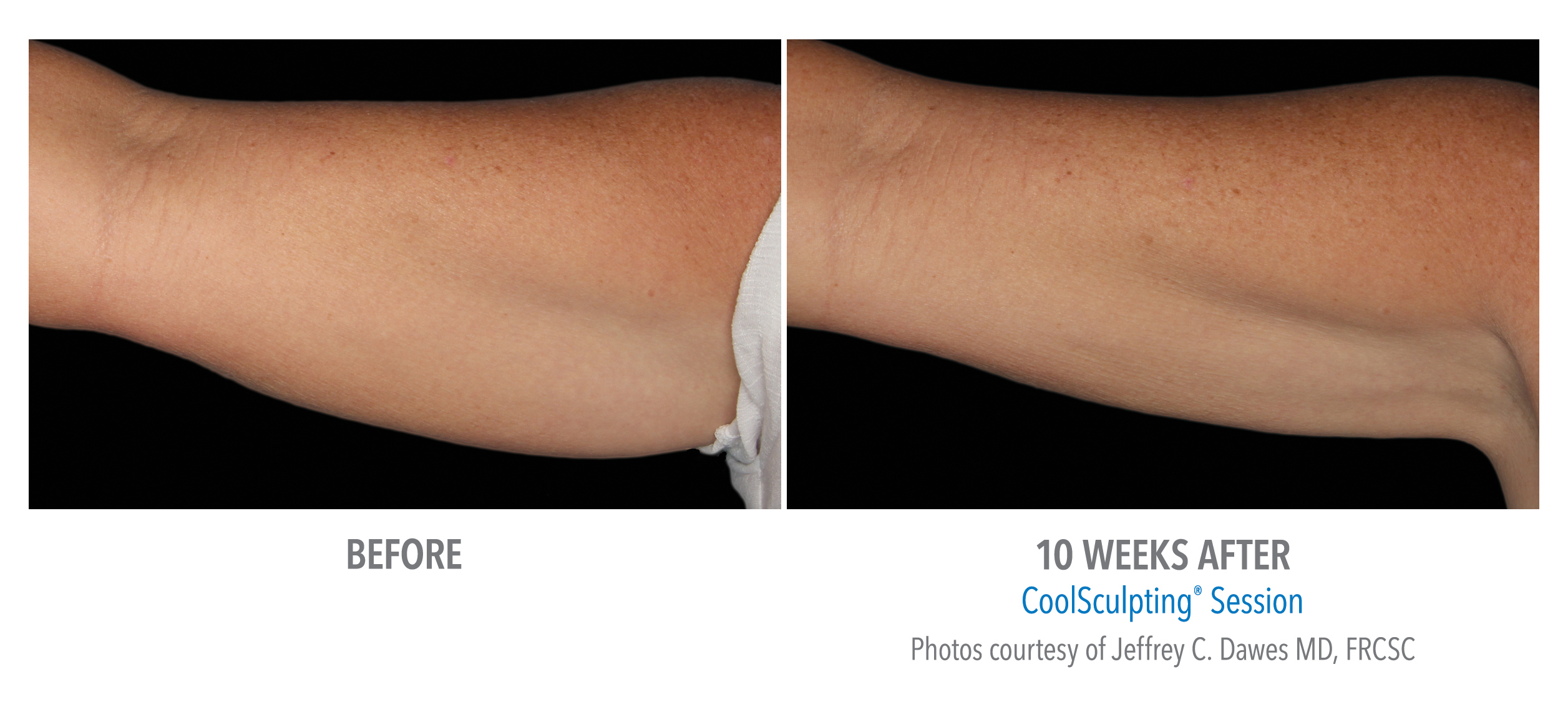 CoolSculpting Before & After Photos | Arms 2
