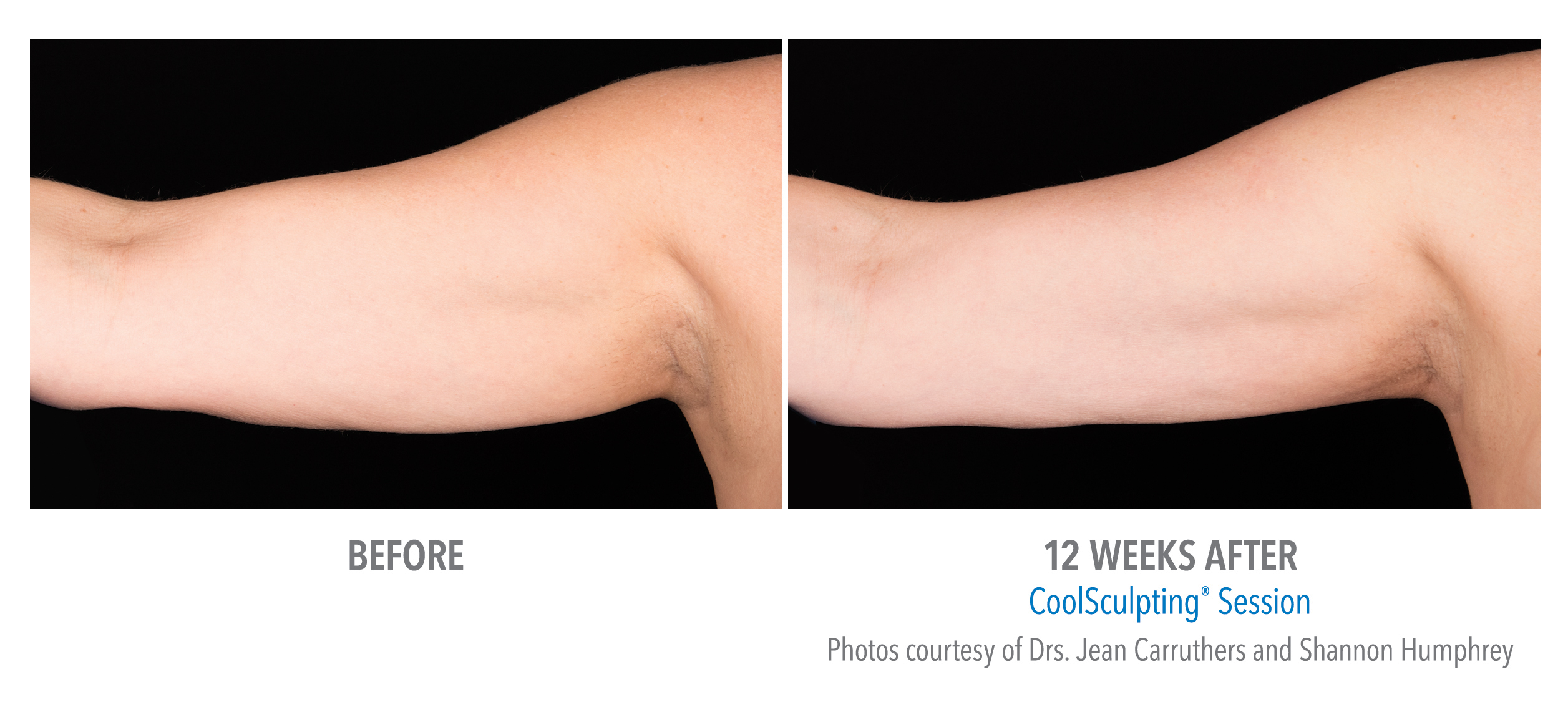 CoolSculpting Before & After Photos | Arms 3