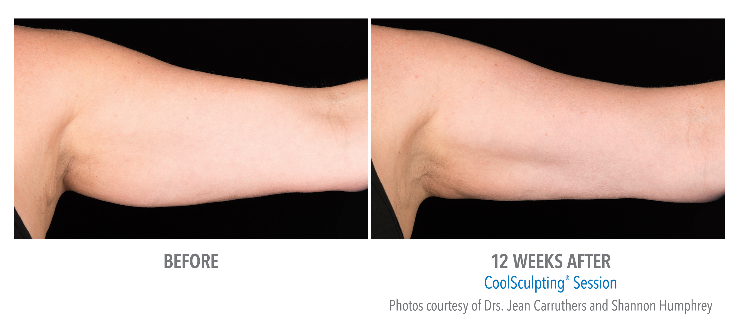 CoolSculpting Before & After Photos | Arms 4