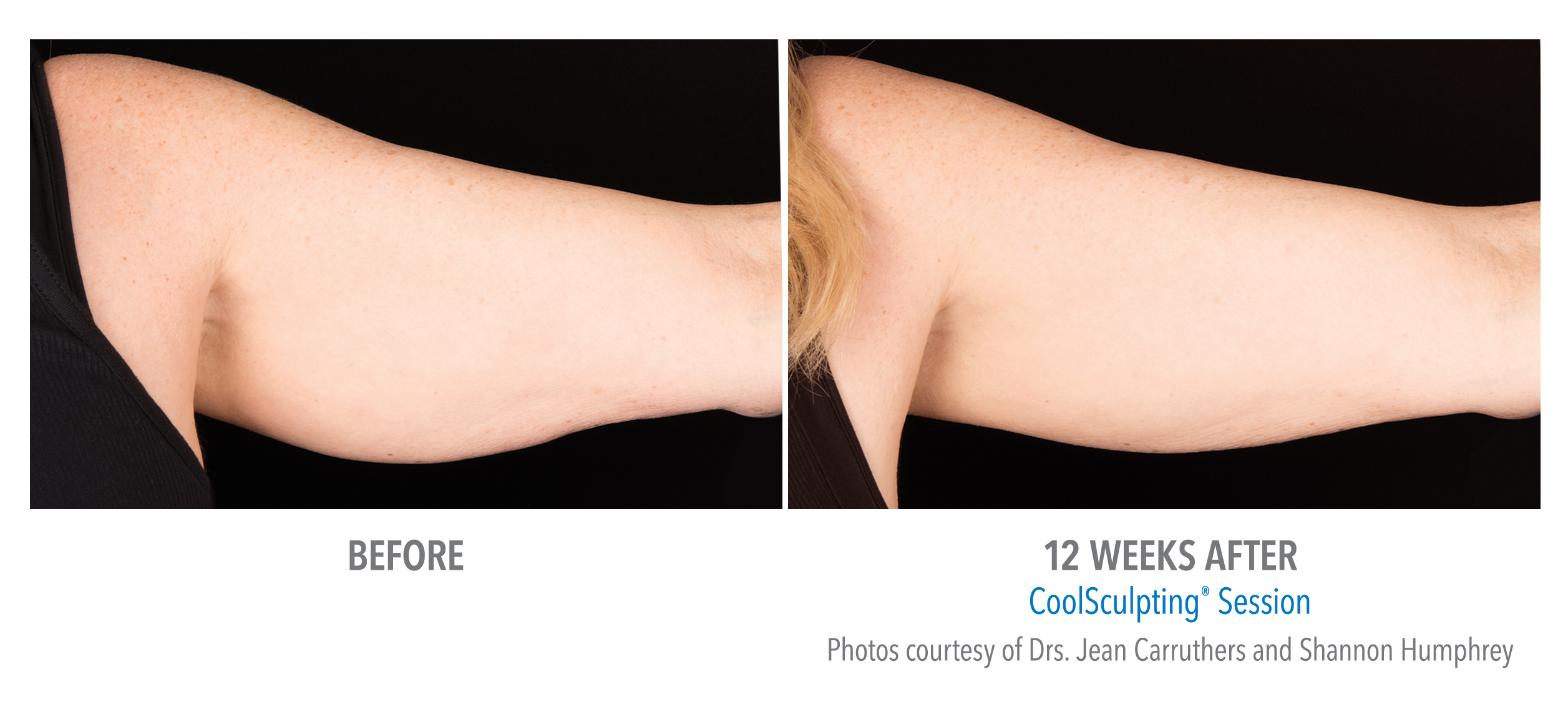 CoolSculpting Before & After Photos | Arms 5