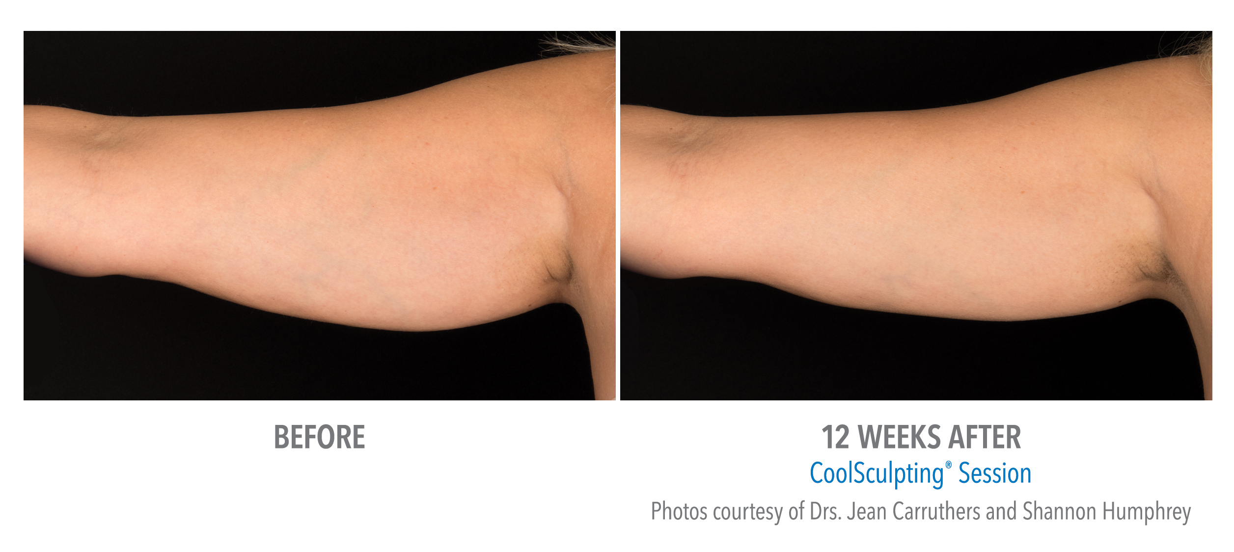 CoolSculpting Before & After Photos | Arms 7