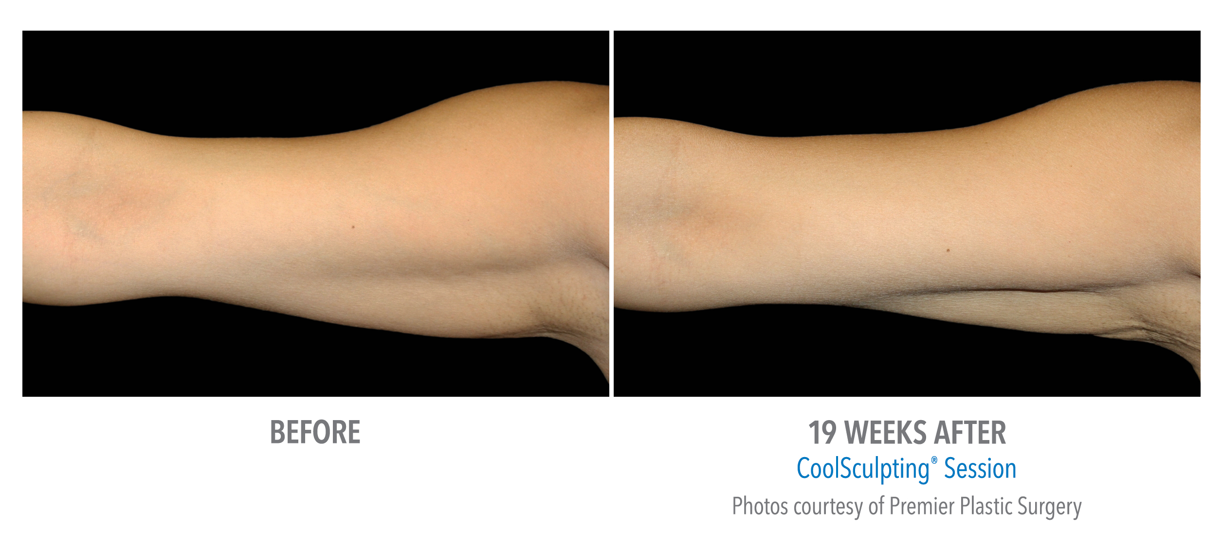 CoolSculpting Before & After Photos | Arms 8