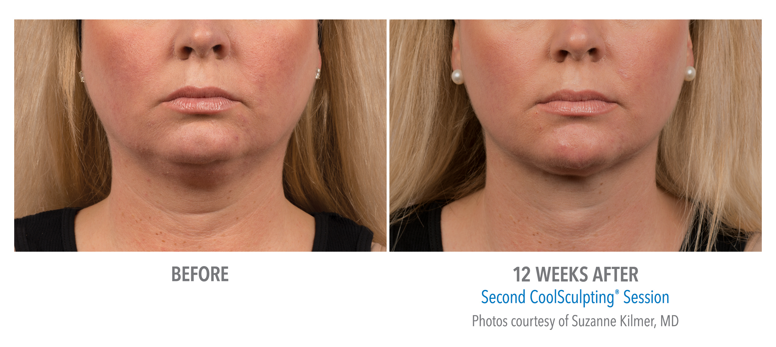 CoolSculpting Before & After Photos | Chin 1