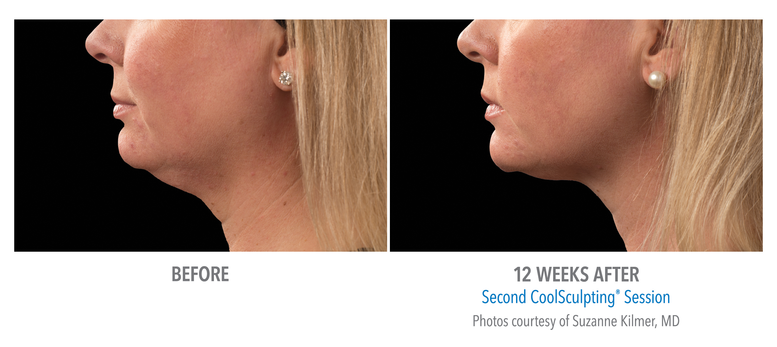 CoolSculpting Before & After Photos | Chin 2