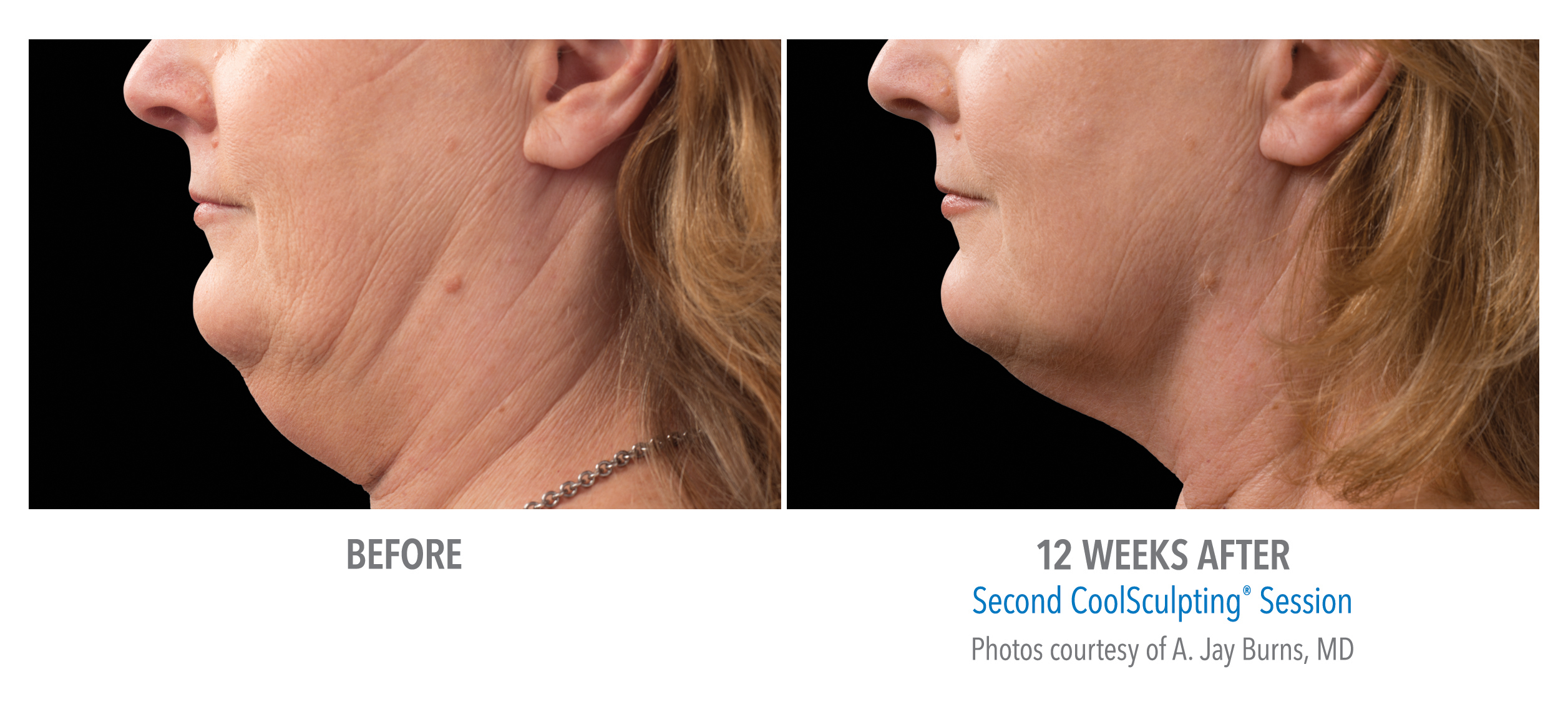CoolSculpting Before & After Photos | Chin 3