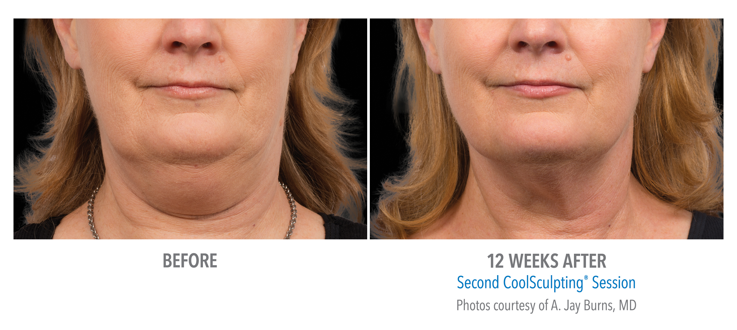 CoolSculpting Before & After Photos | Chin 4
