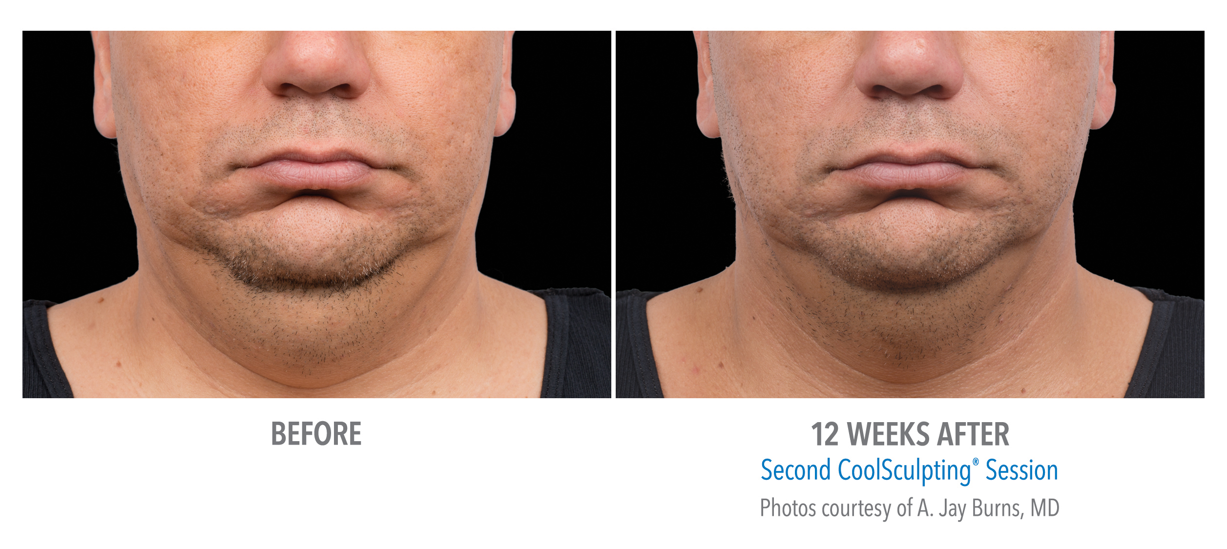 CoolSculpting Before & After Photos | Chin 5