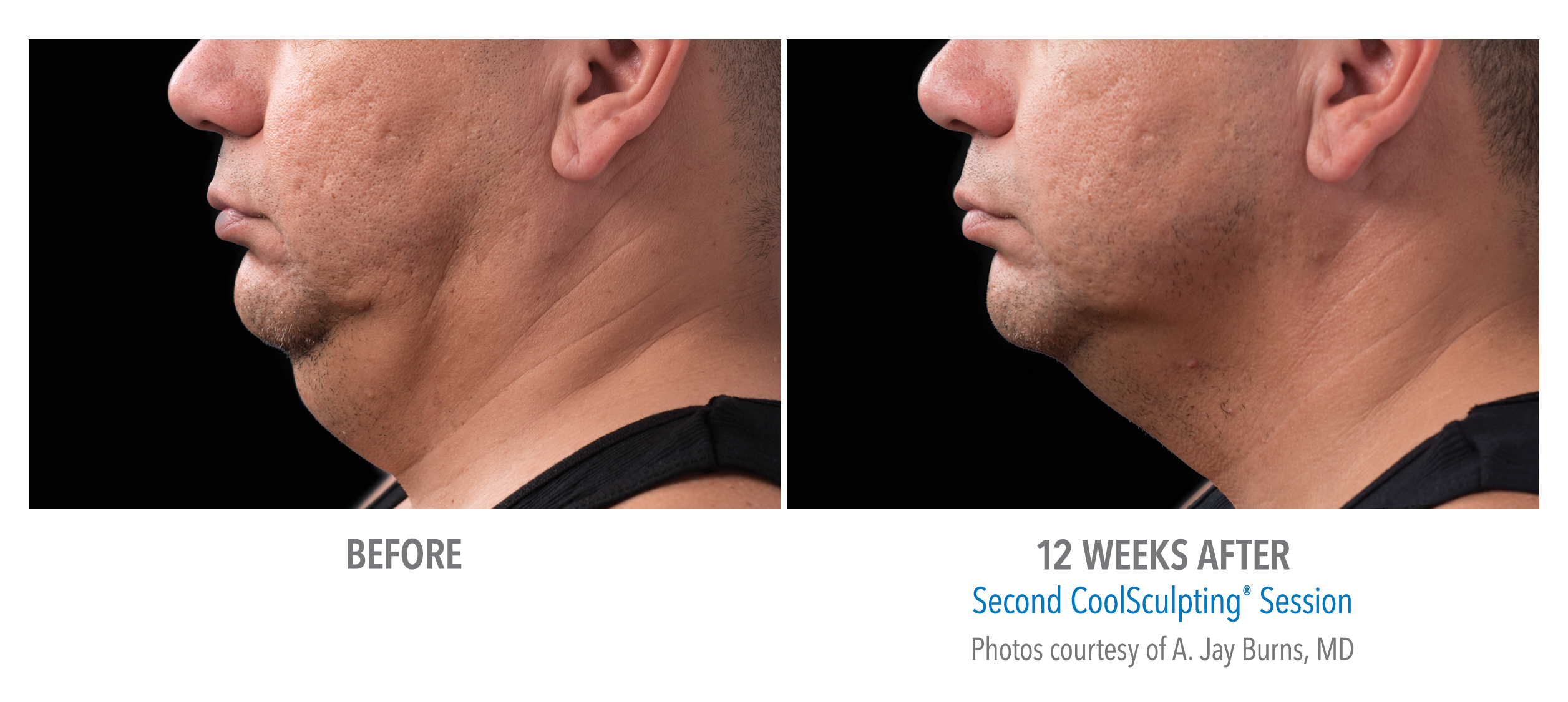 CoolSculpting Before & After Photos | Chin 6