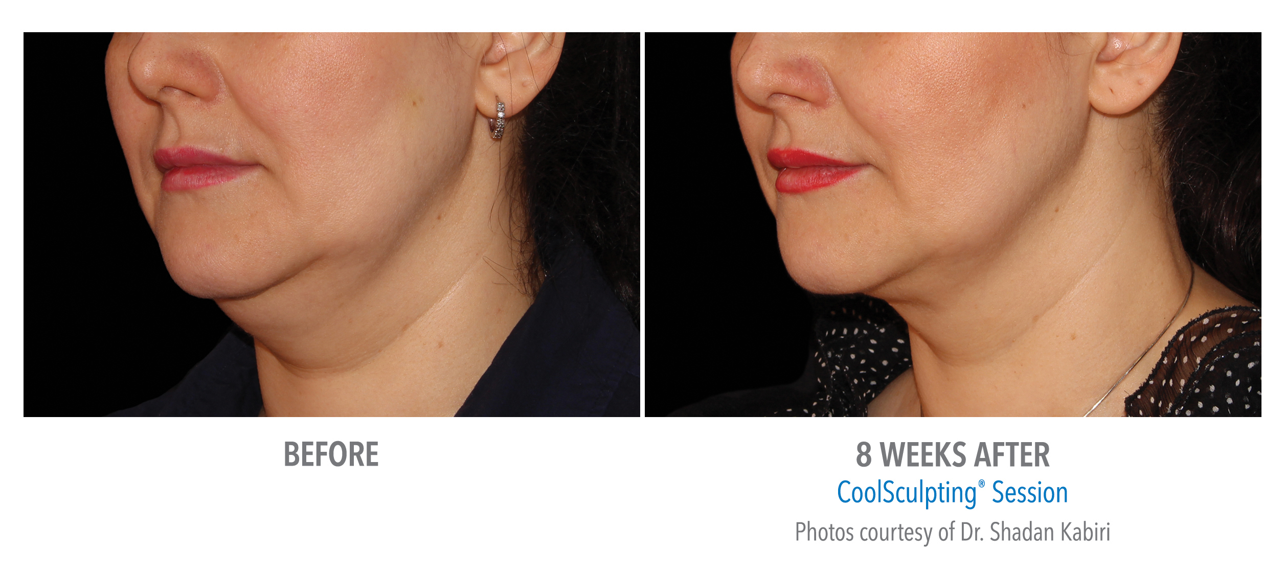 CoolSculpting Before & After Photos | Chin 7