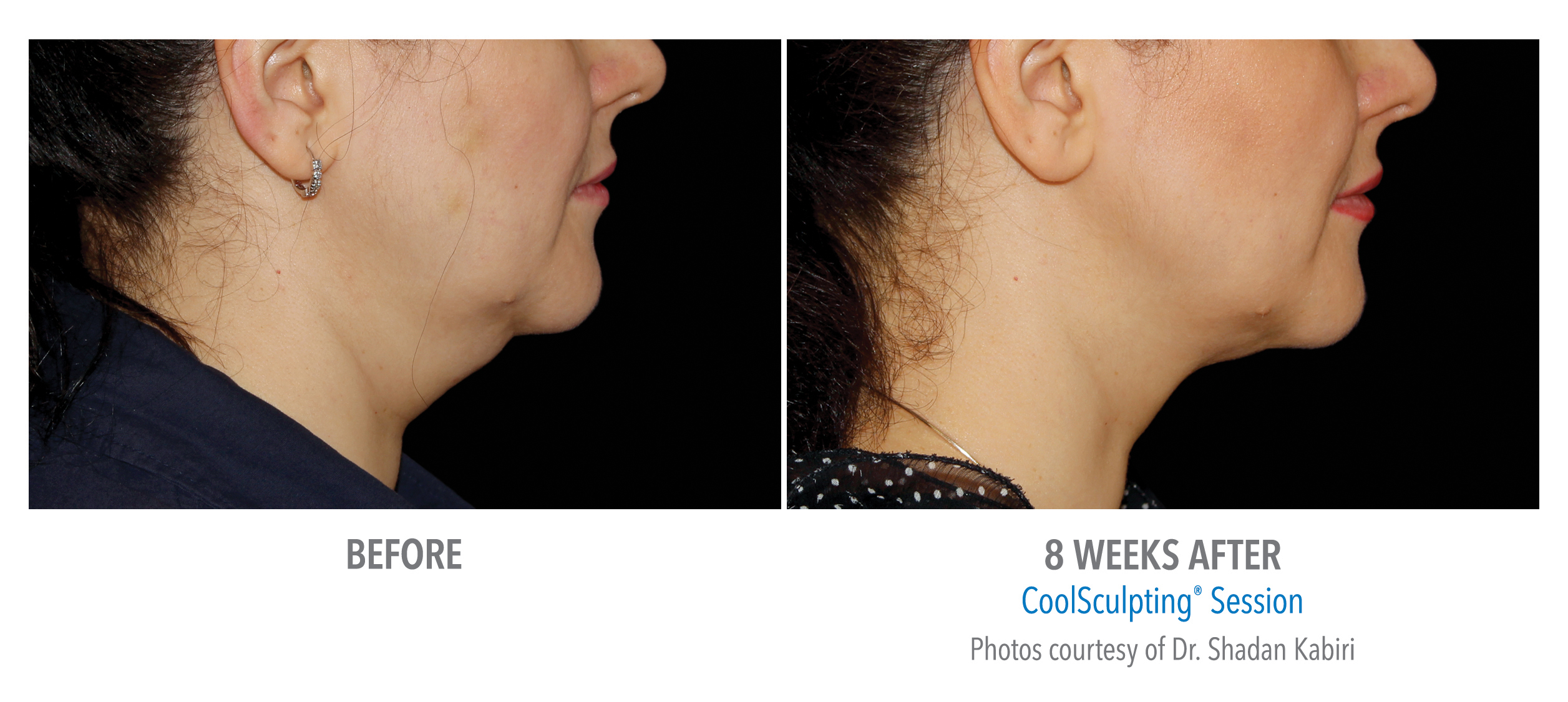 CoolSculpting Before & After Photos | Chin 8