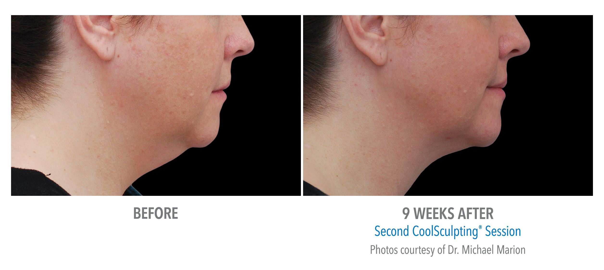 CoolSculpting Before & After Photos | Chin 9