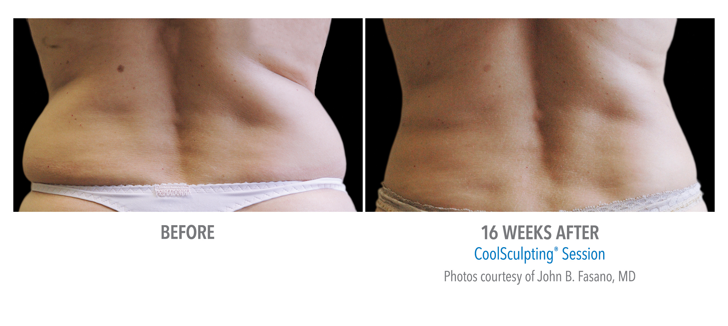 CoolSculpting Before & After Photos | Flanks 2