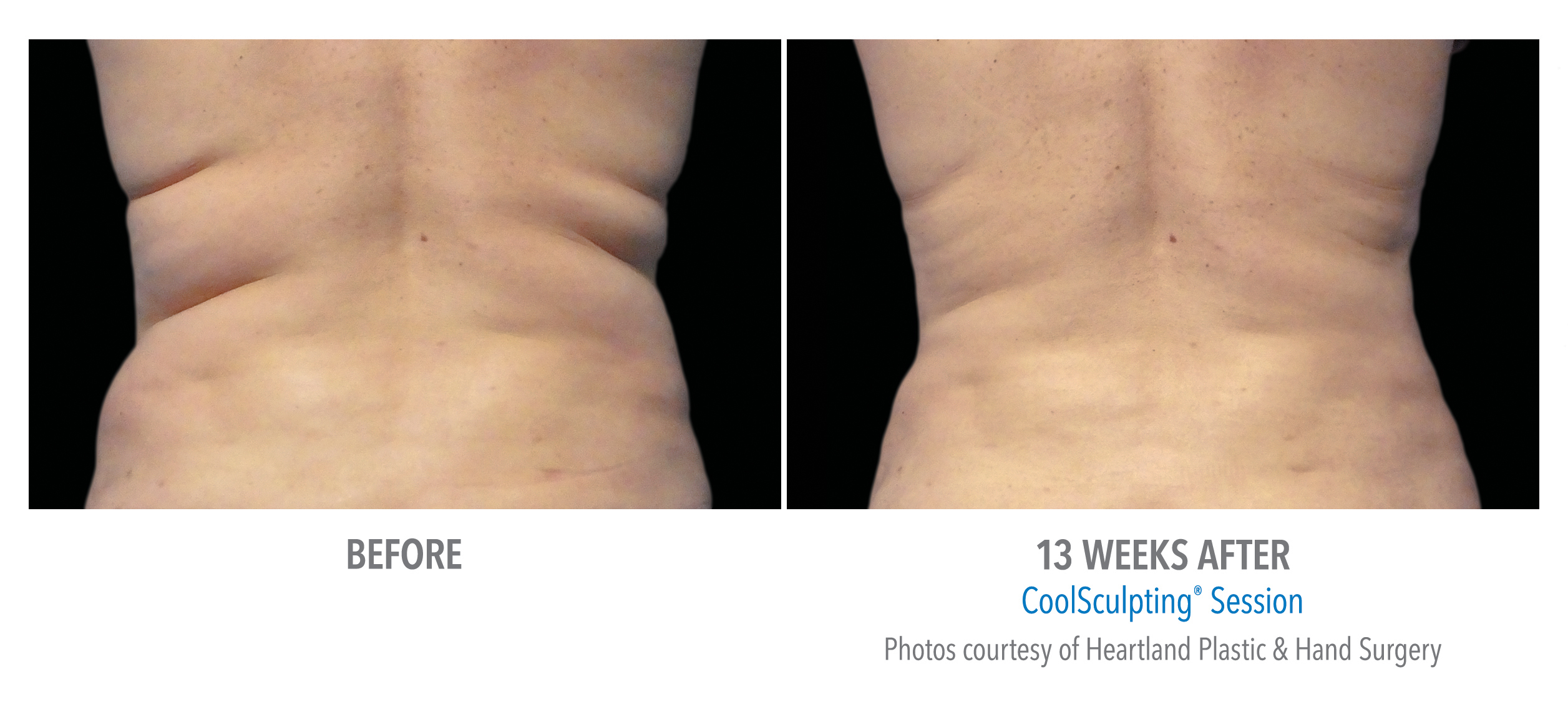 CoolSculpting Before & After Photos | Flanks 3
