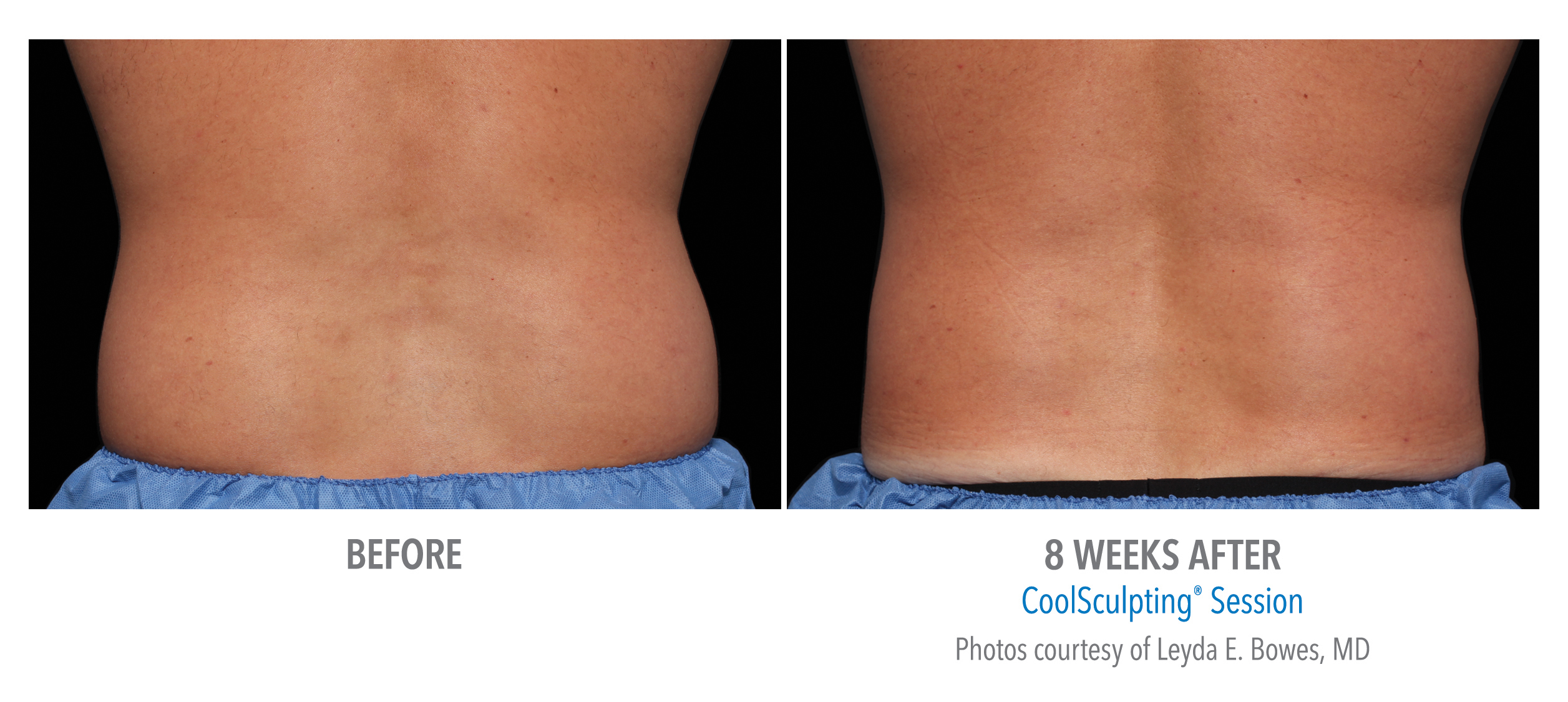 CoolSculpting Before & After Photos | Flanks 4