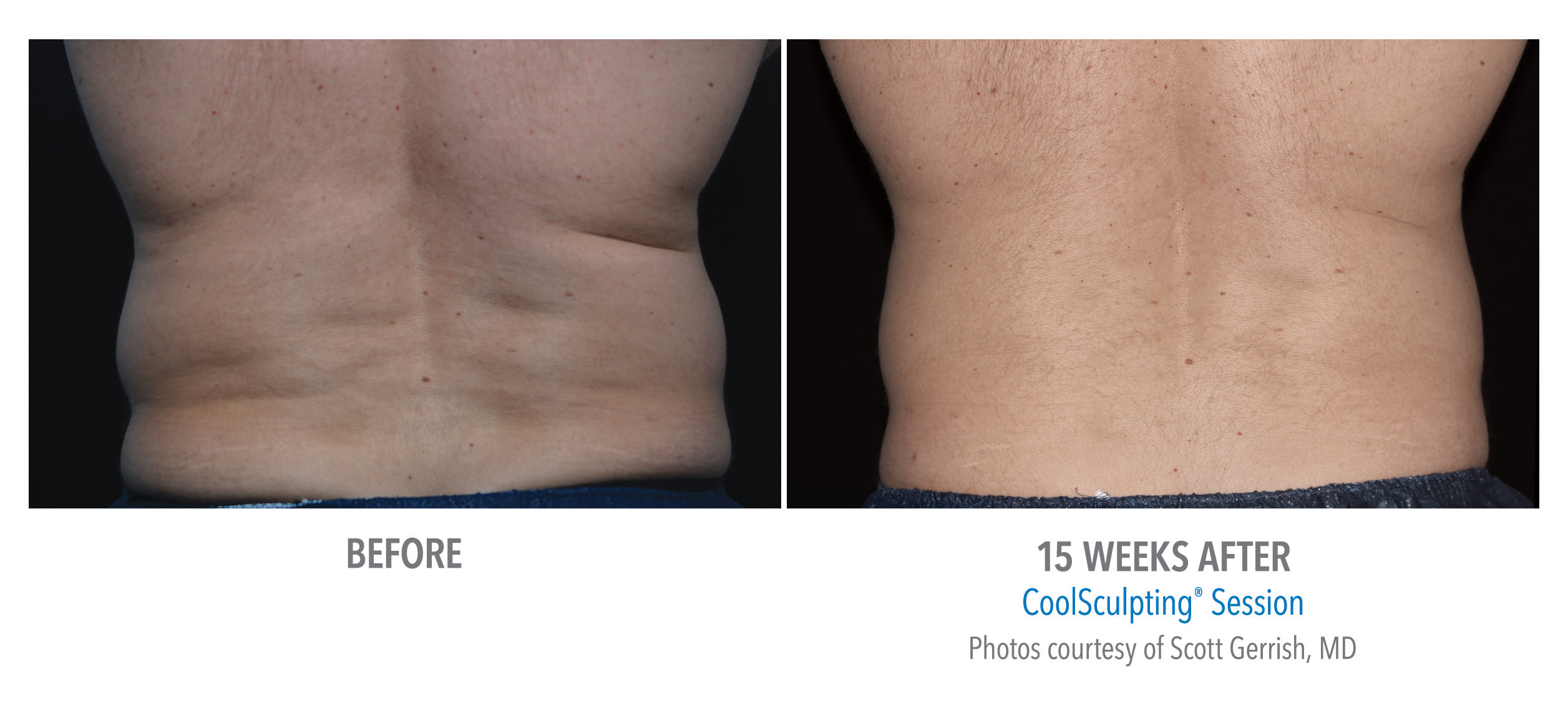 CoolSculpting Before & After Photos | Flanks 5