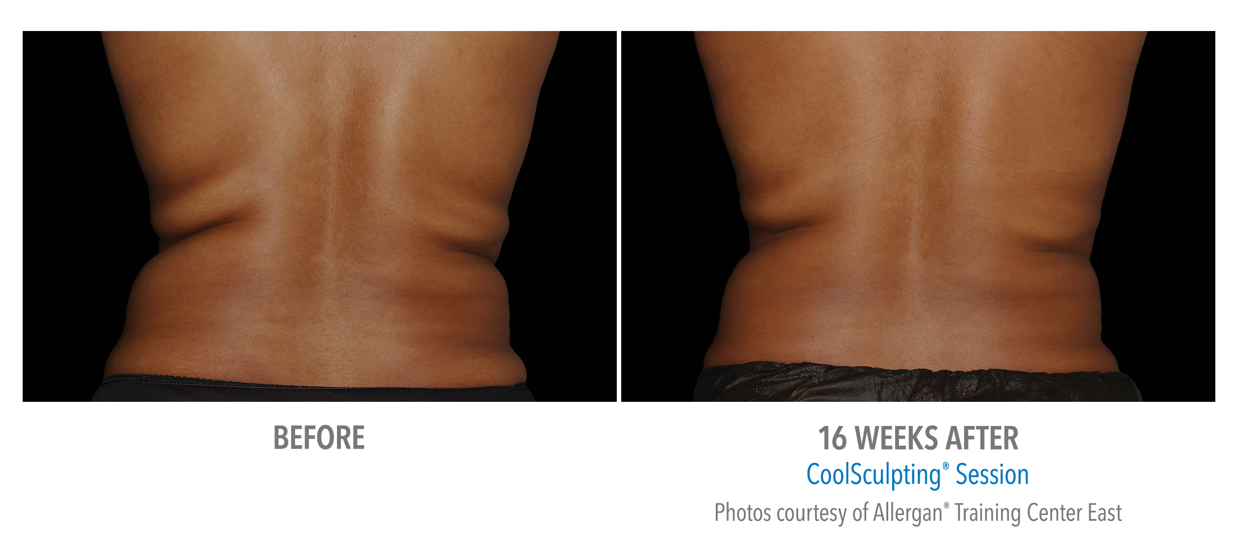 CoolSculpting Before & After Photos | Flanks 6