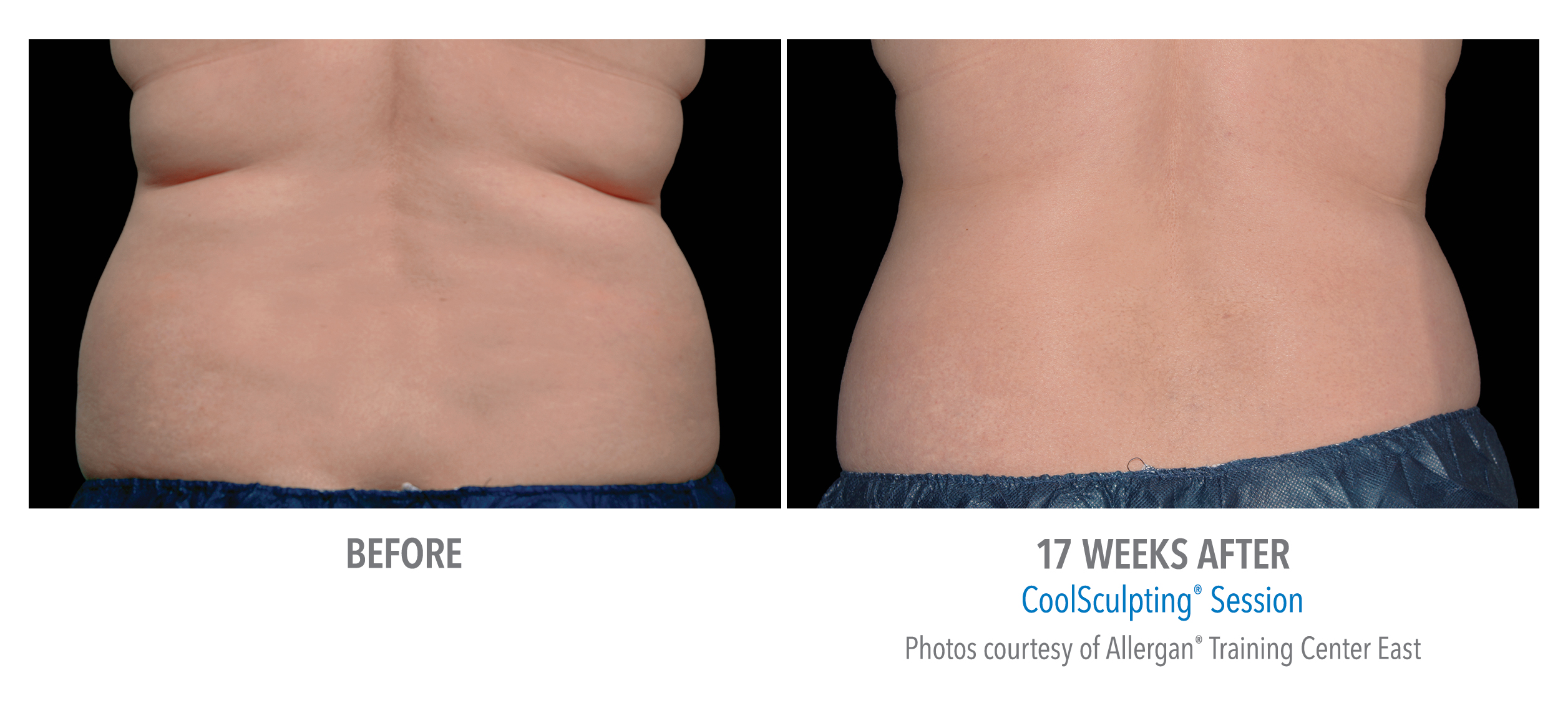 CoolSculpting Before & After Photos | Flanks 8