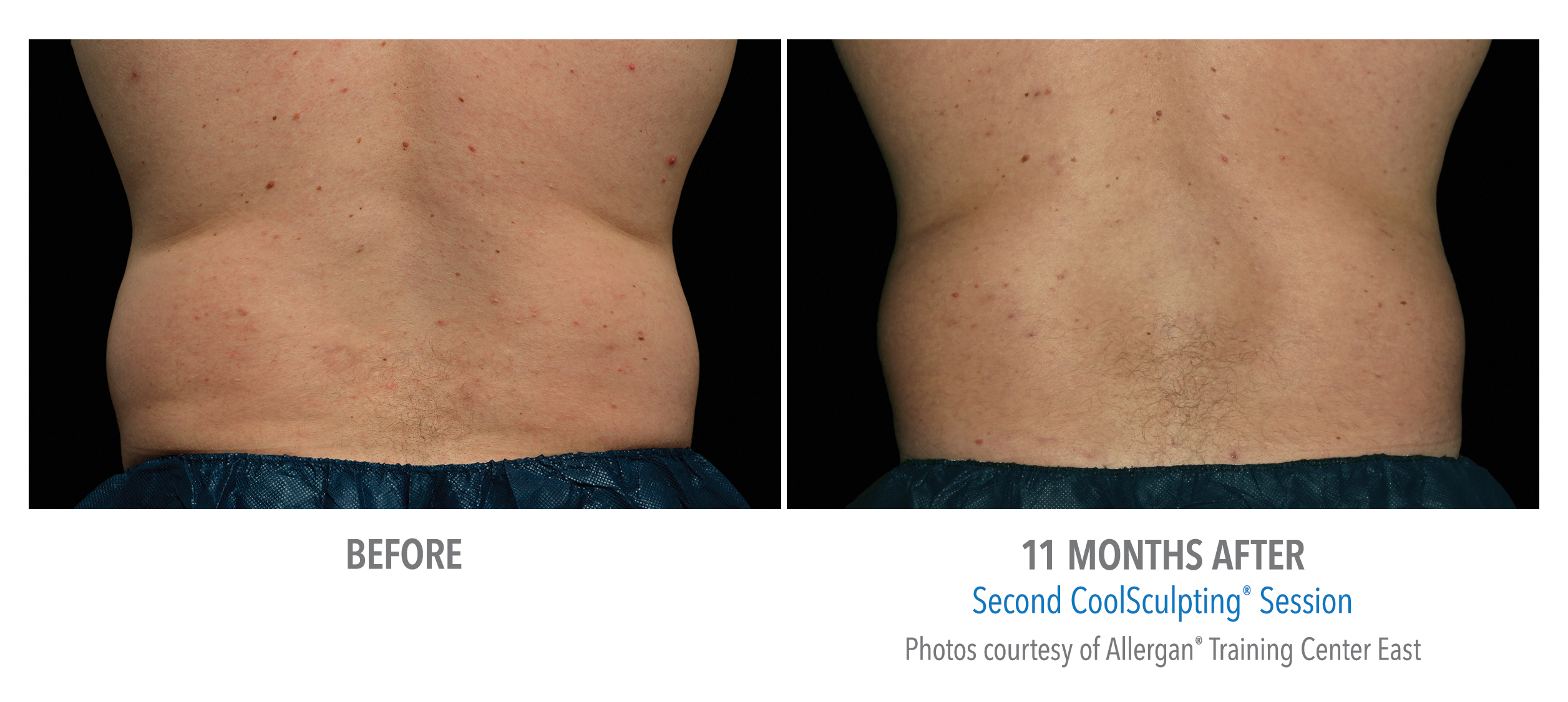 CoolSculpting Before & After Photos | Flanks 9