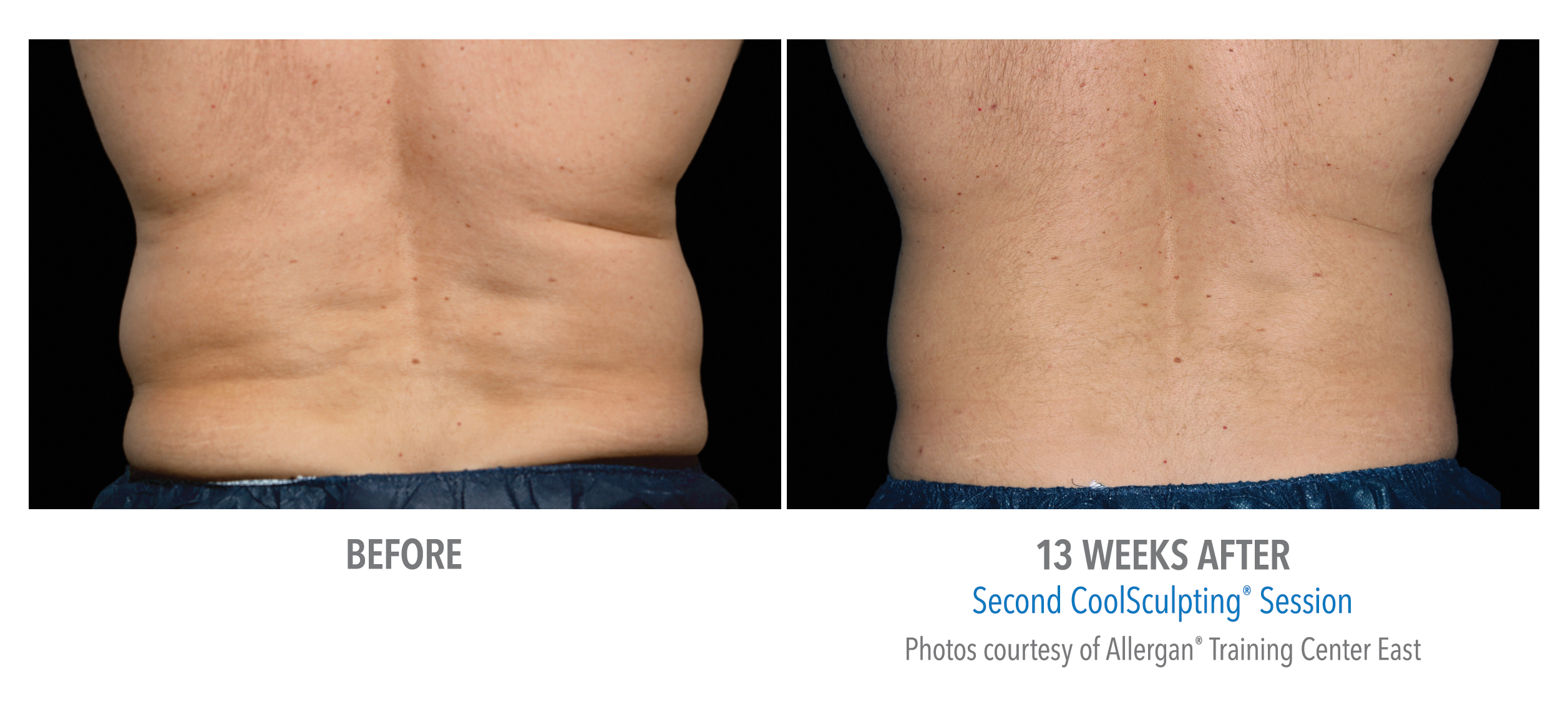 CoolSculpting Before & After Photos | Flanks 10