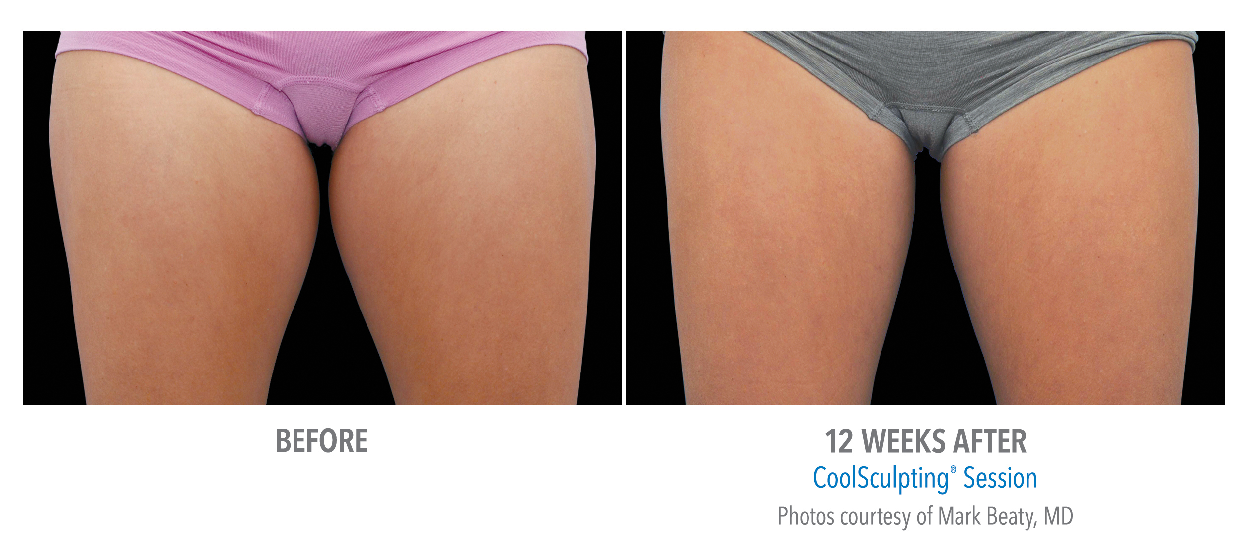 CoolSculpting Before & After Photos | Thighs 4