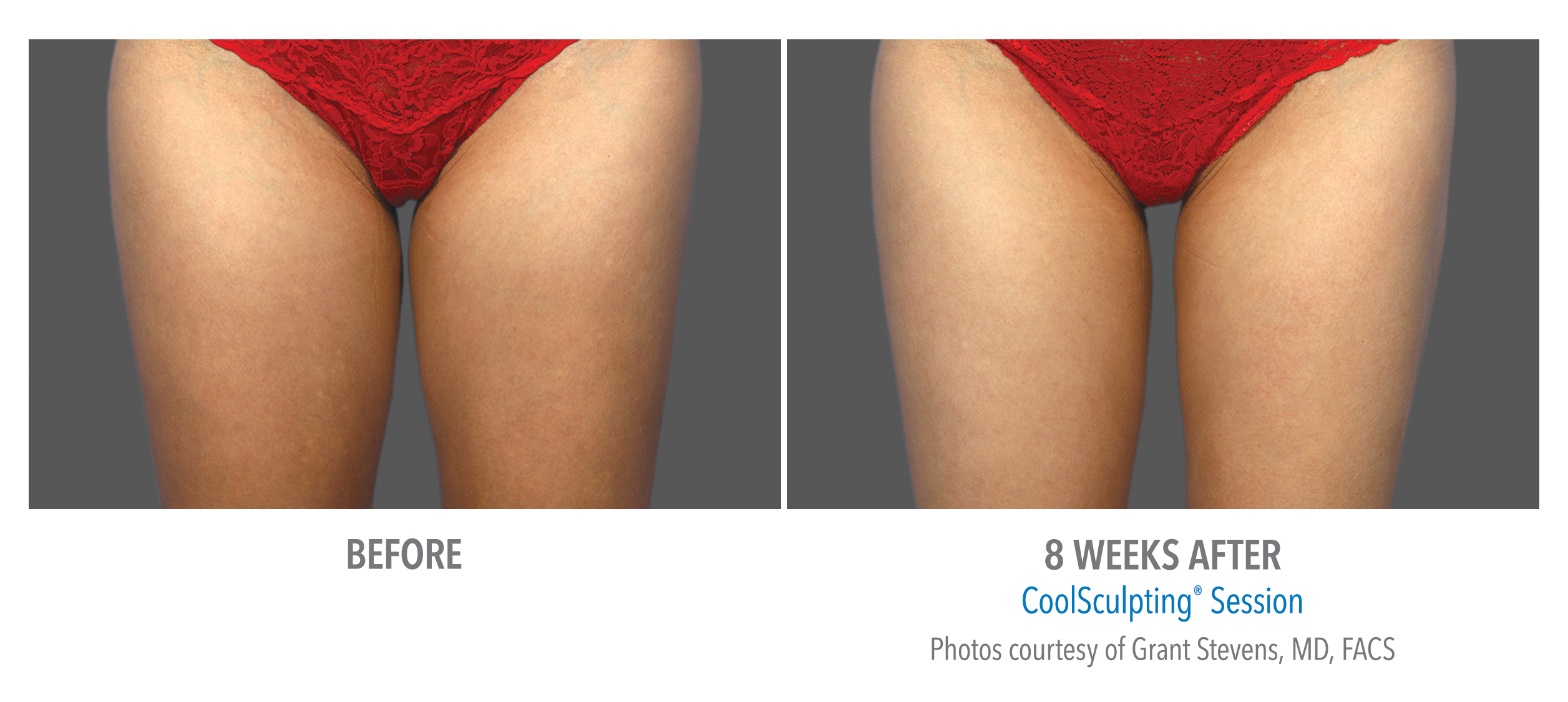 CoolSculpting Before & After Photos | Thighs 2