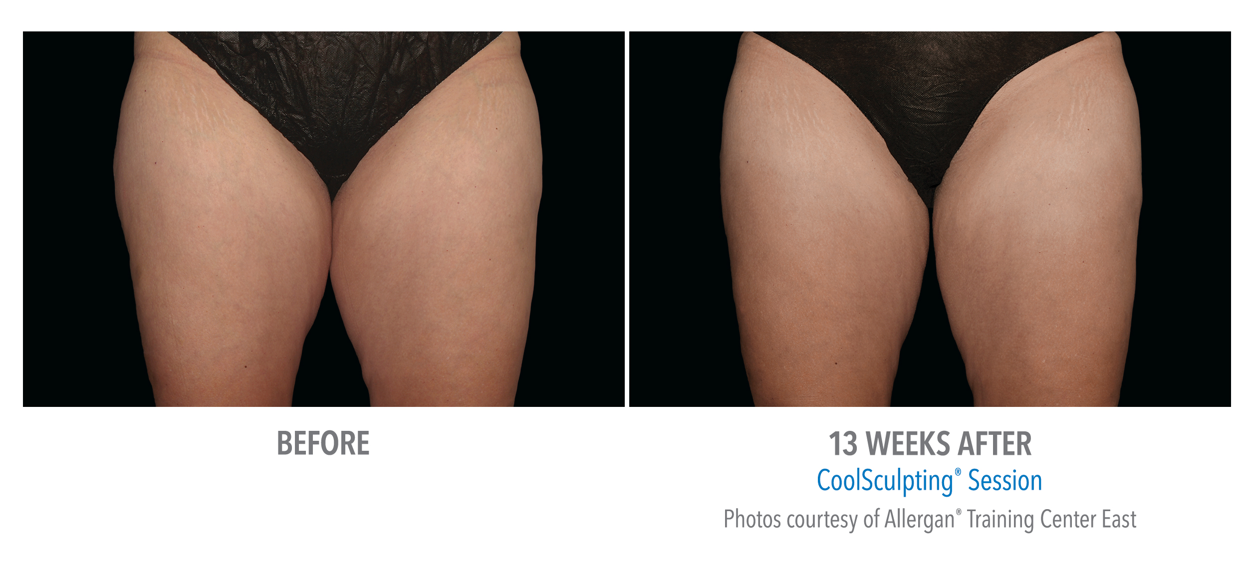 CoolSculpting Before & After Photos | Thighs 6
