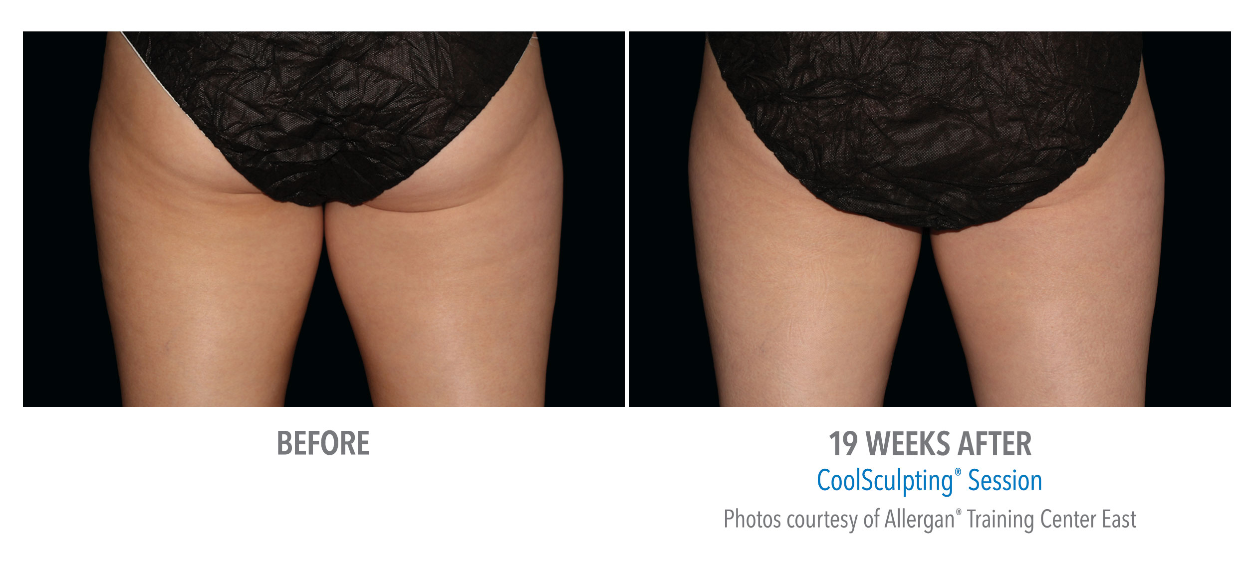 CoolSculpting Before & After Photos | Thighs 7
