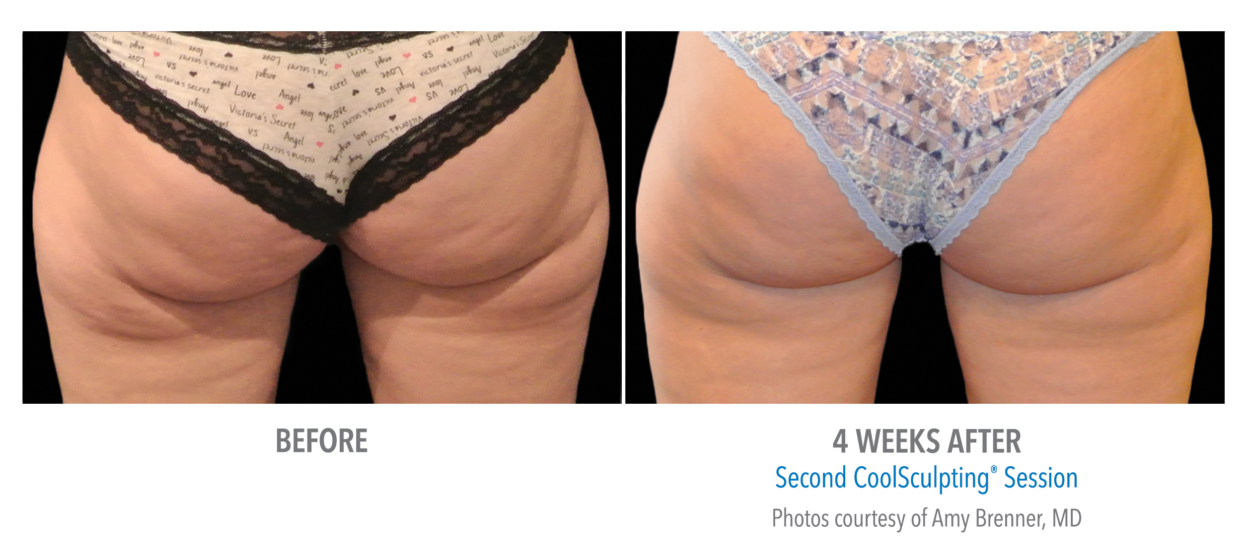 CoolSculpting Before & After Photos | Buttocks and Banana Rolls 1