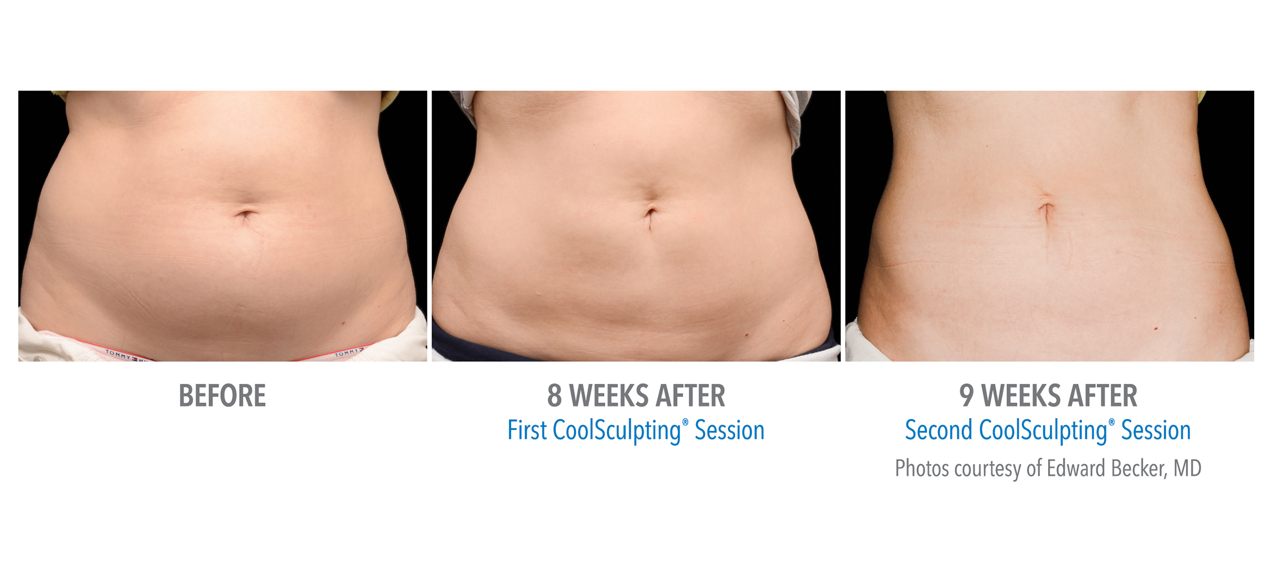 CoolSculpting Before & After Photos | Abdomen 1