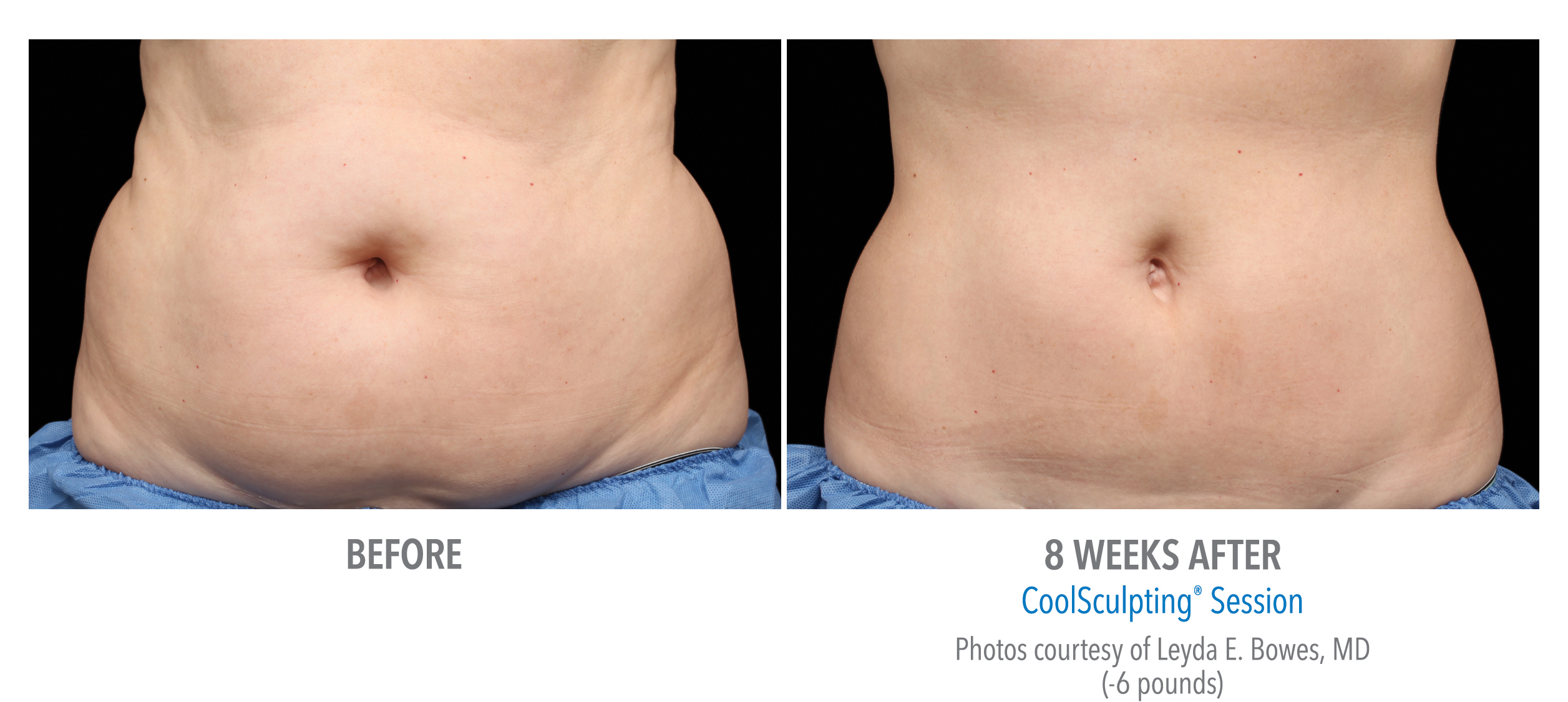 CoolSculpting Before & After Photos | Abdomen 2