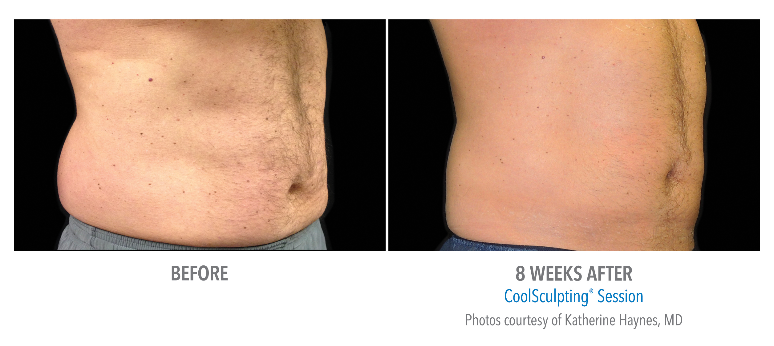 CoolSculpting Before & After Photos | Abdomen 3