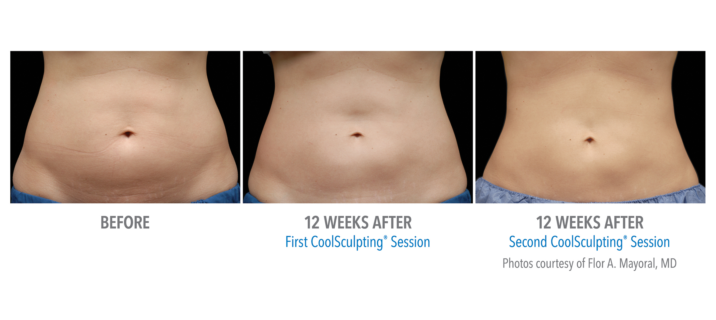 CoolSculpting Before & After Photos | Abdomen 4