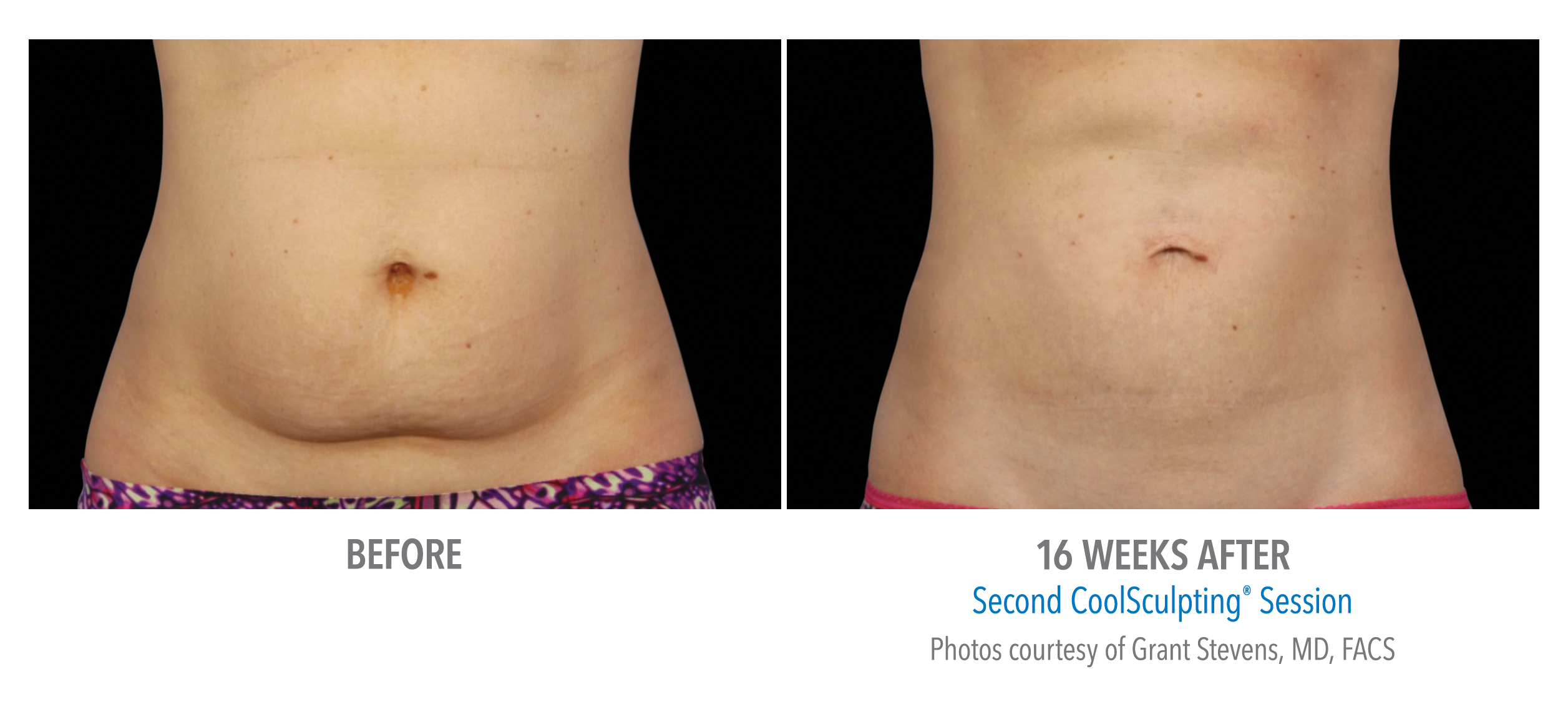 CoolSculpting Before & After Photos | Abdomen 5
