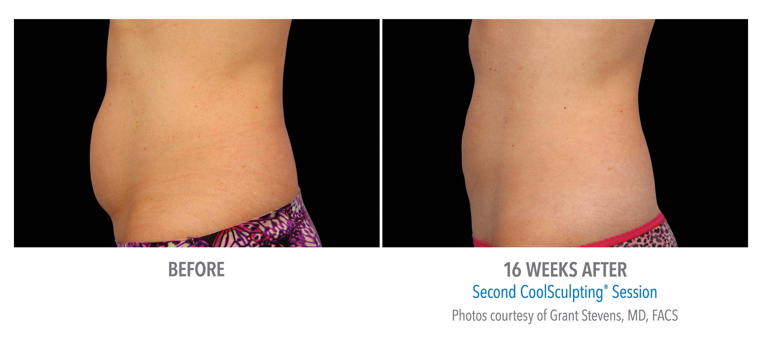 CoolSculpting Before & After Photos | Abdomen 6