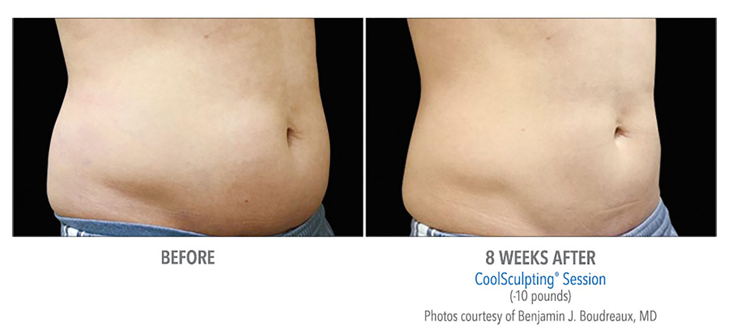 CoolSculpting Before & After Photos | Abdomen 7