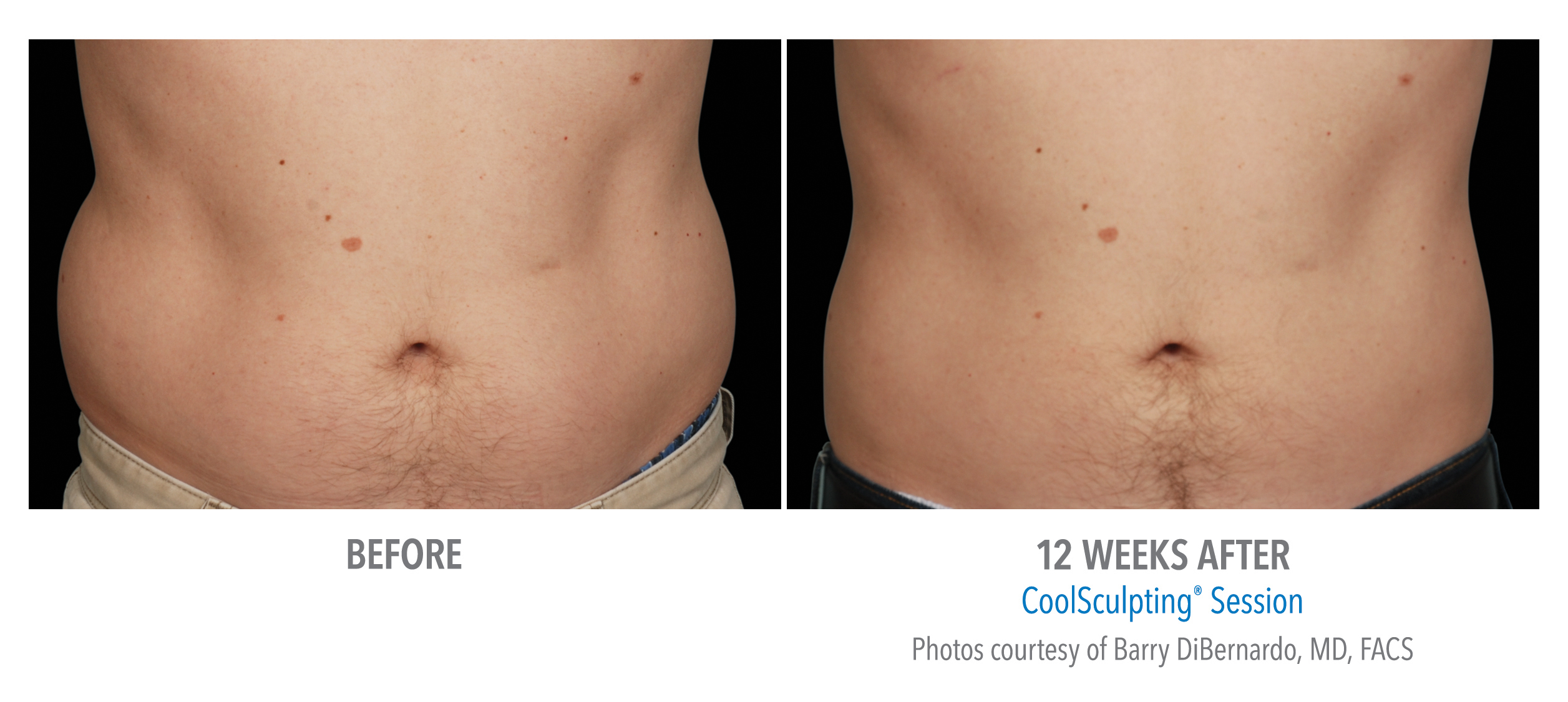 CoolSculpting Before & After Photos | Abdomen 8
