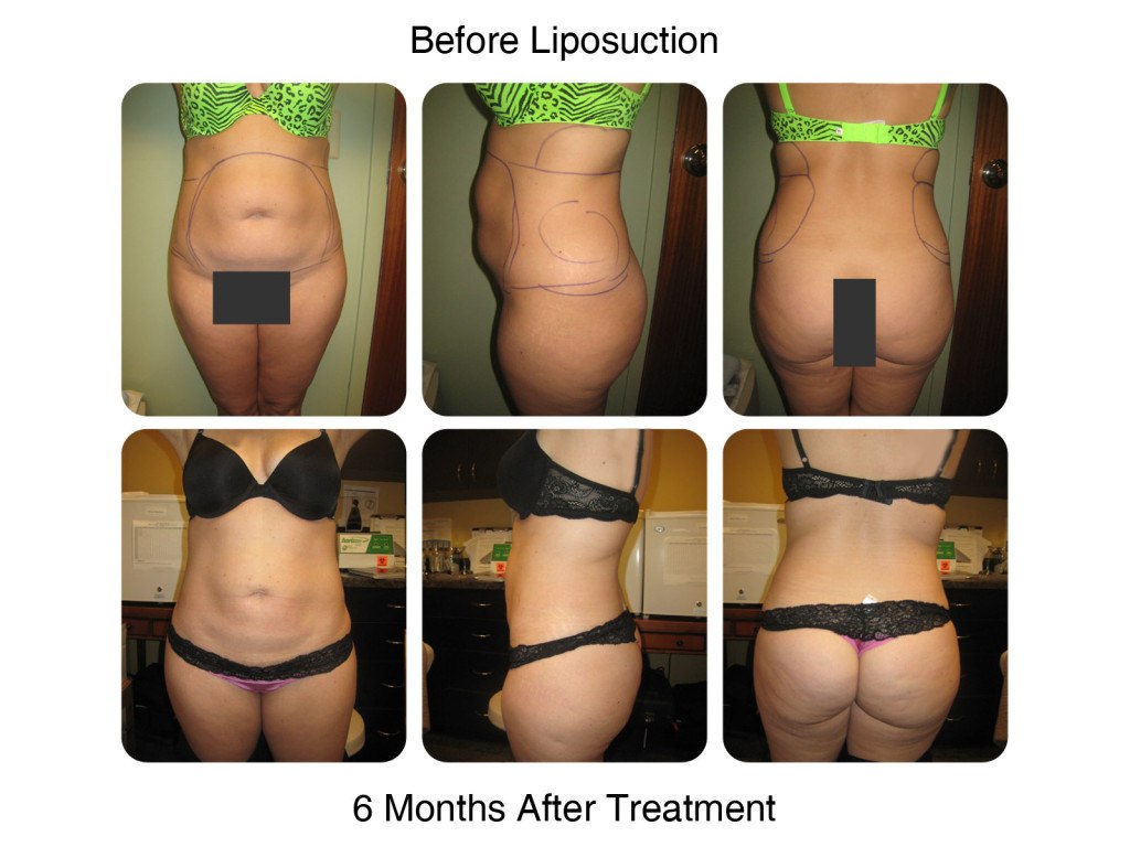 Smart Liposuction Fat Removal Before and After 1