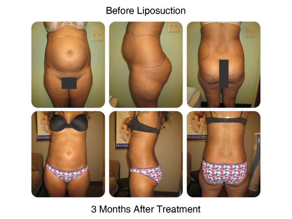 Smart Liposuction Fat Removal Before and After 2