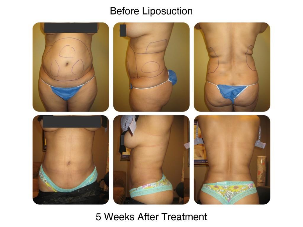 Smart Liposuction Fat Removal Before and After 3