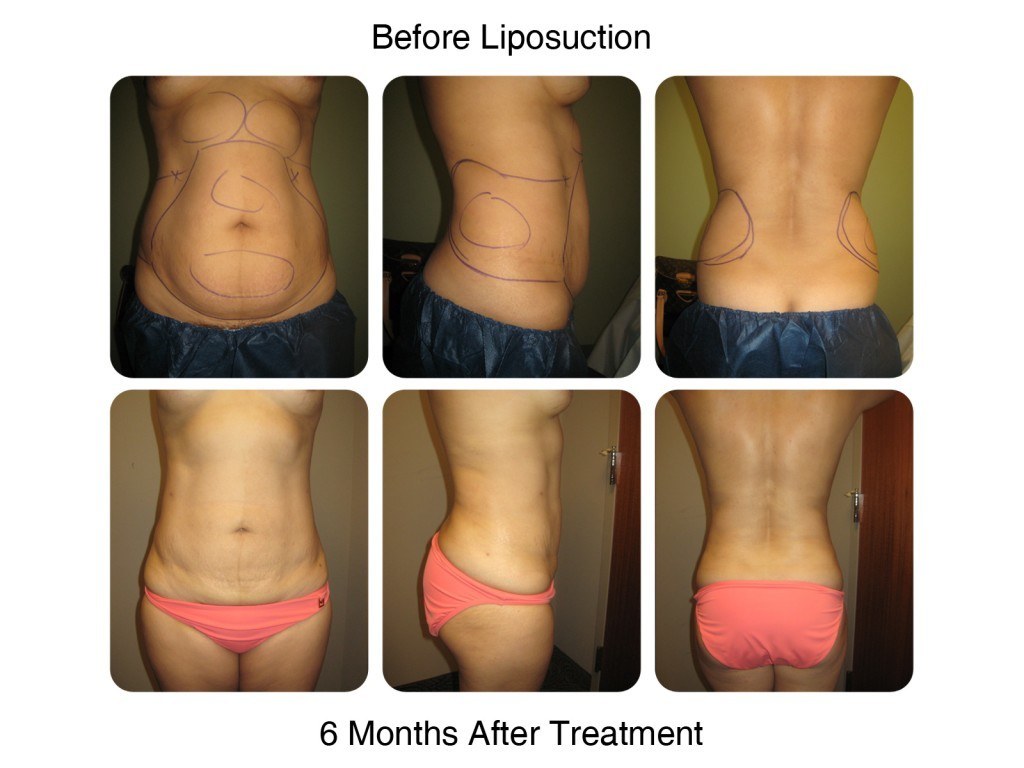 Smart Liposuction Fat Removal Before and After 4