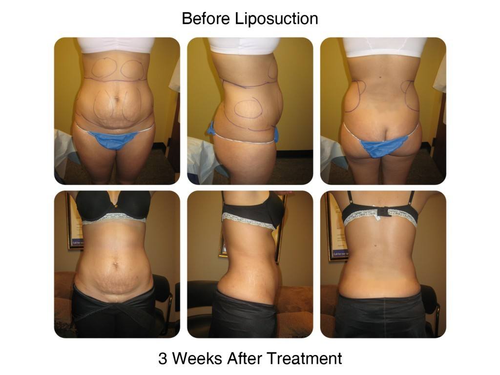Smart Liposuction Fat Removal Before and After 5