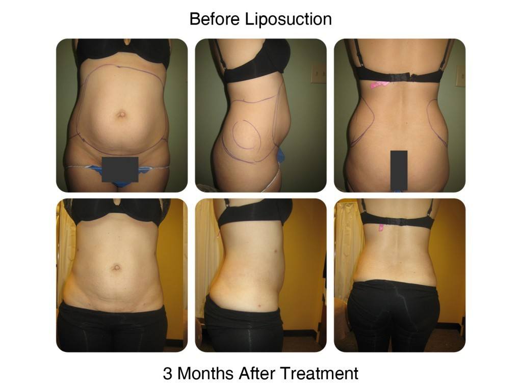 Smart Liposuction Fat Removal Before and After 6