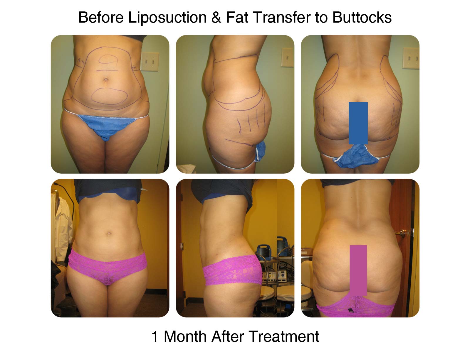 Brazilian Butt Lift Fat Transfer Before and After 2