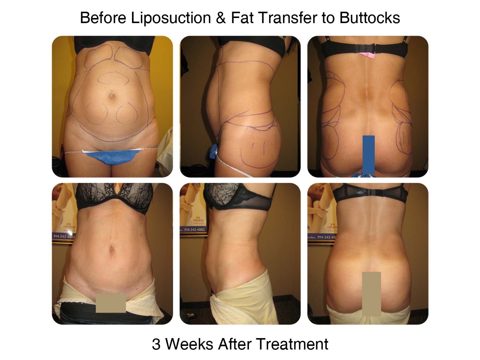 Brazilian Butt Lift Fat Transfer Before and After 3
