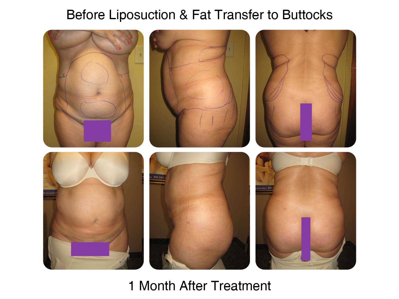 Brazilian Butt Lift Fat Transfer Before and After 4
