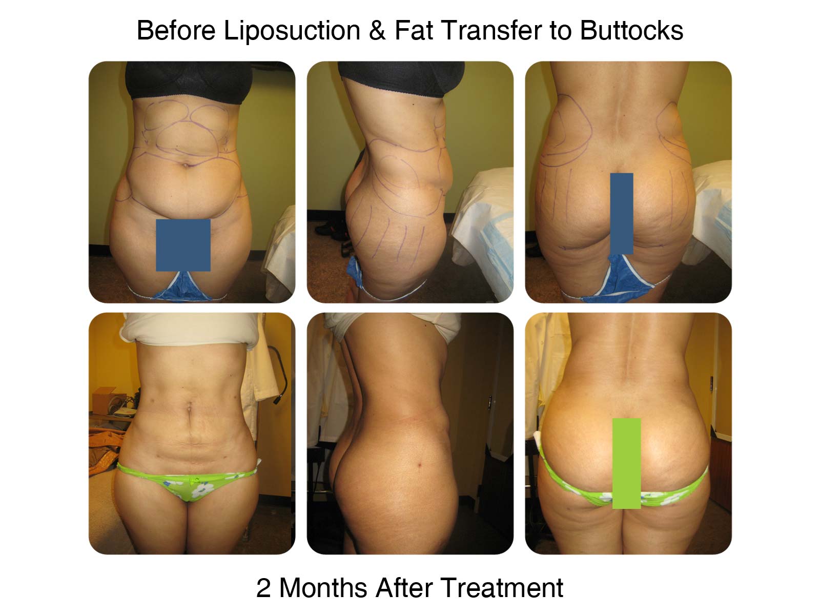 Brazilian Butt Lift Fat Transfer Before and After 5