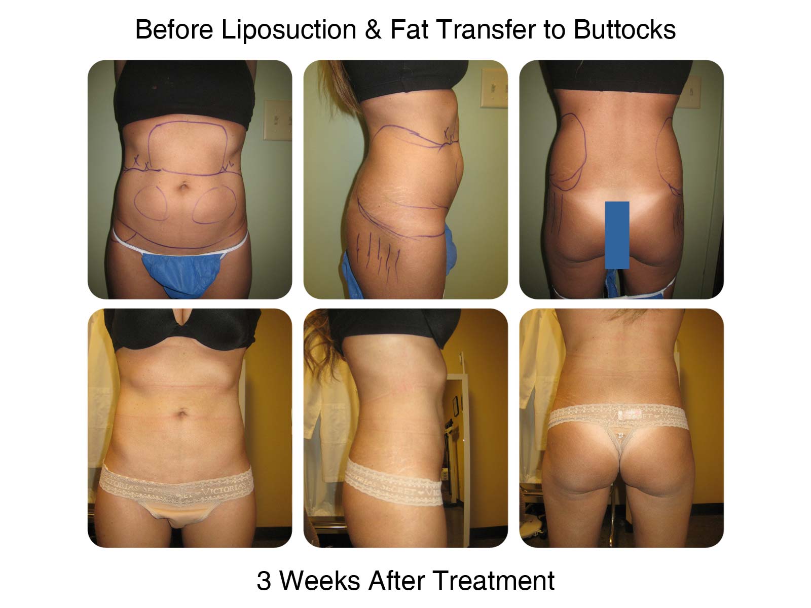 Brazilian Butt Lift Fat Transfer Before and After 6