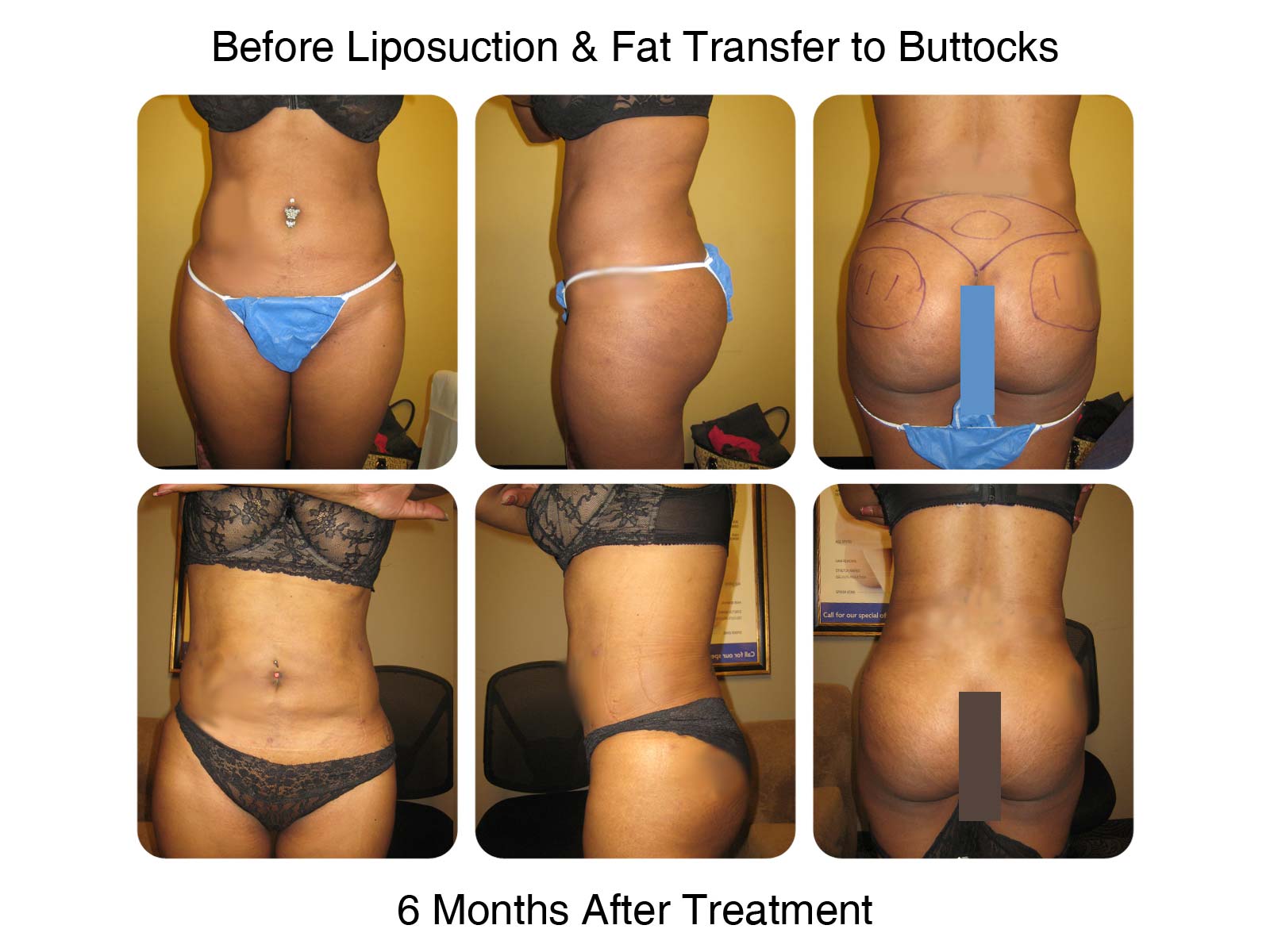 Brazilian Butt Lift Fat Transfer Before and After 7