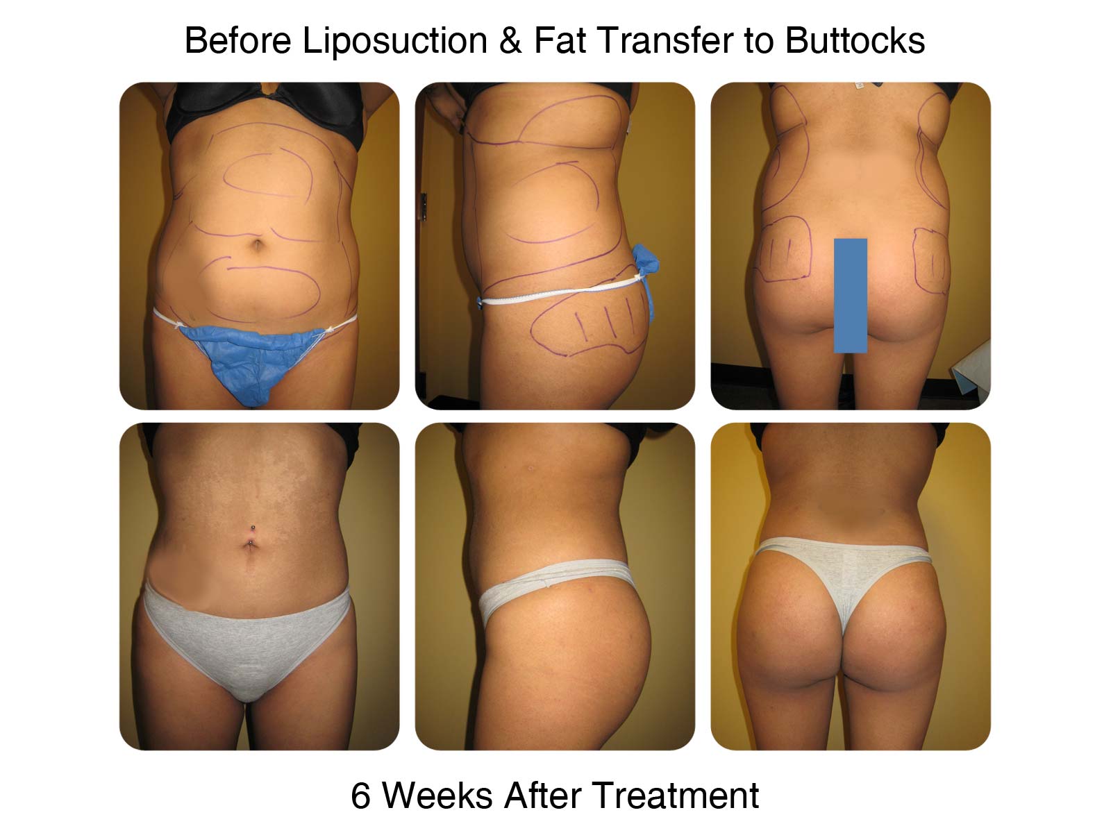 Brazilian Butt Lift Fat Transfer Before and After 8