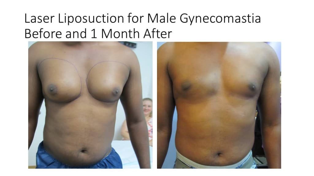 Male Breast Reduction Liposuction Before and After 1